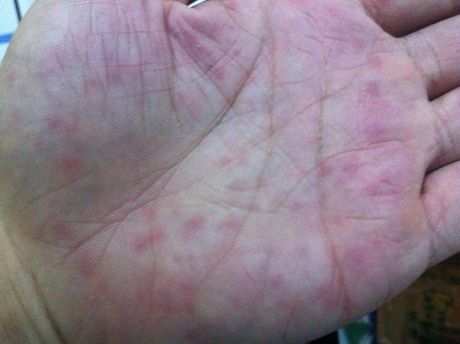 手心有很多红斑点是怎么回事,双手都有,如图