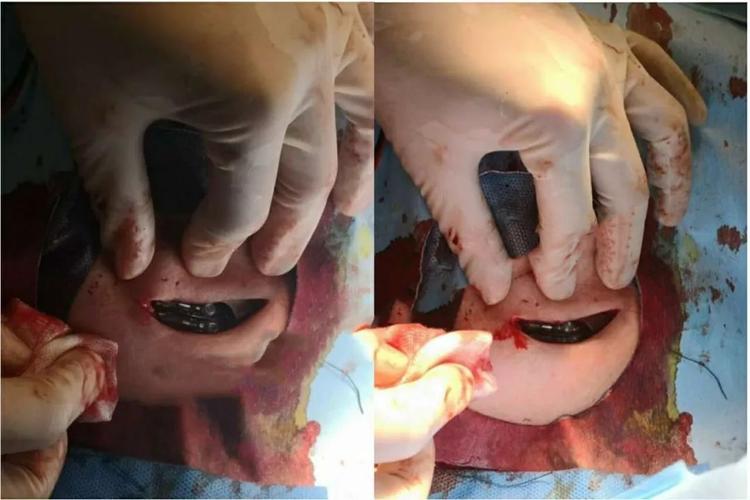 新蔡同安医院首例永久性人工心脏起搏器植入术成功开展!