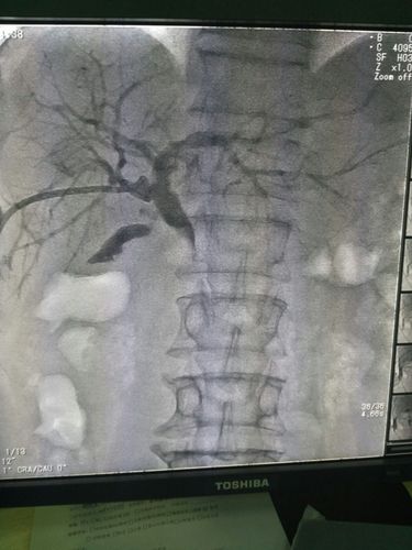 皮肤黄染别大意,胰腺胆管是祸首,无法开刀别害怕,微创介入来帮忙!