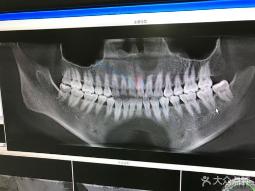 小白兔口腔(未央分院)牙齿ct图片 - 第1张