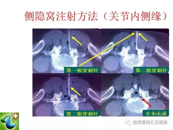 侧隐窝,椎间孔注射等临床实用技术