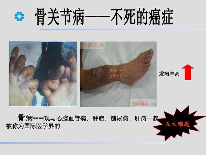 骨关节疾病ppt