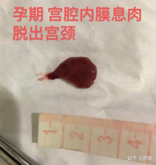 常伴随其他疾病:有子宫肌瘤者,有痛经月经多者,检查常废种