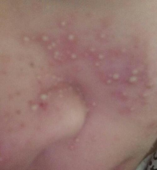 吃火锅脸上起像痘痘一样的小白点,特别痒,脸特别红是怎么回事