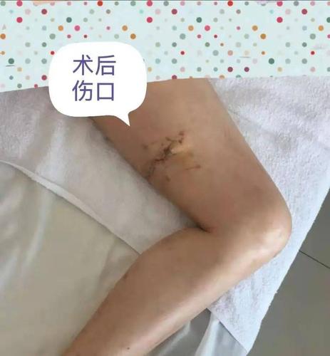 郭永良主任,王争刚副主任医师查看病人后,果断指示行急诊手术行钢筋