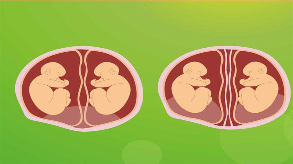 同卵双胞胎指两个胎儿由一个受精卵发育而成,异卵双胞胎是由不同的