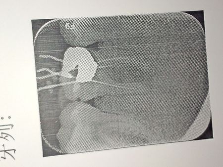 我的牙齿有侧穿或者低穿吗