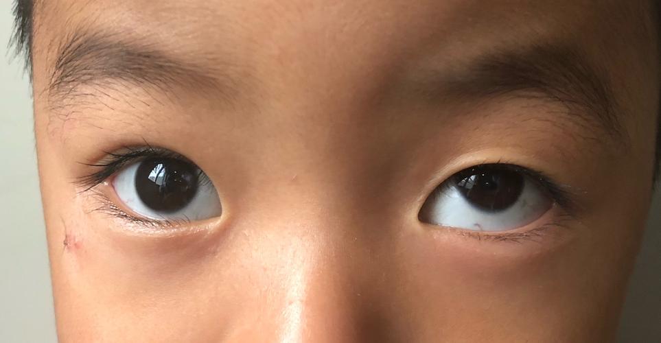 儿童斜视千万不要"等等看"