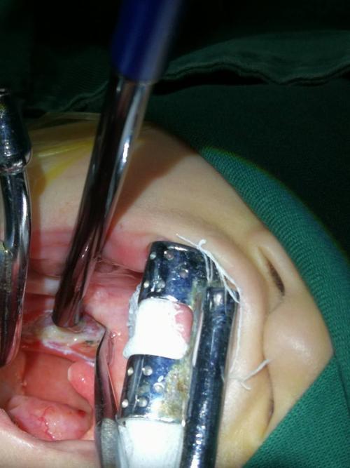 双扁桃体低温等离子切除术