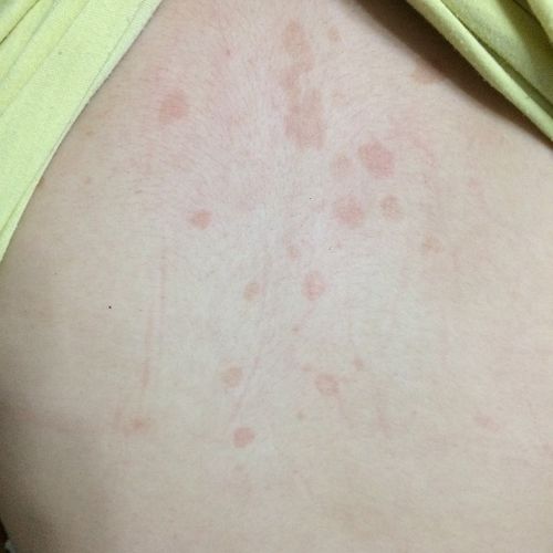 背上最近出现红斑,不痛不痒,没有任何感觉,但是感觉在