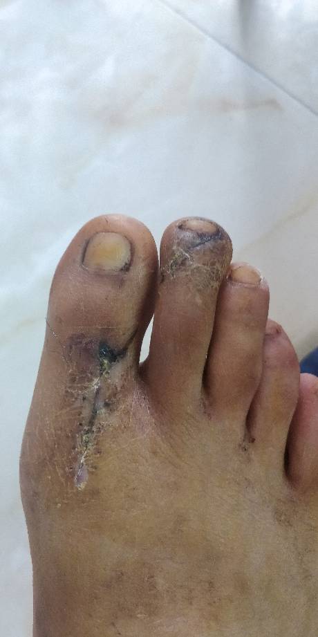 大脚趾肌腱断裂拆了石膏后能碰水吗