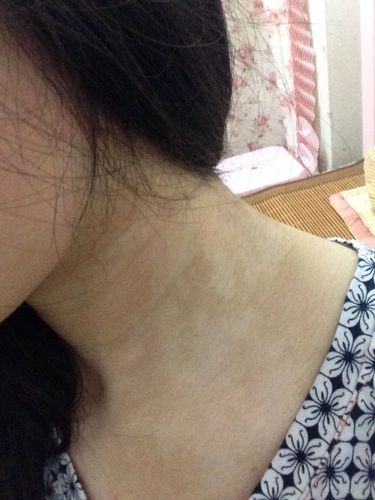 的白斑 不是很白 从挺小就有了 一直没有扩散 这是白癜风吗 还是胎记