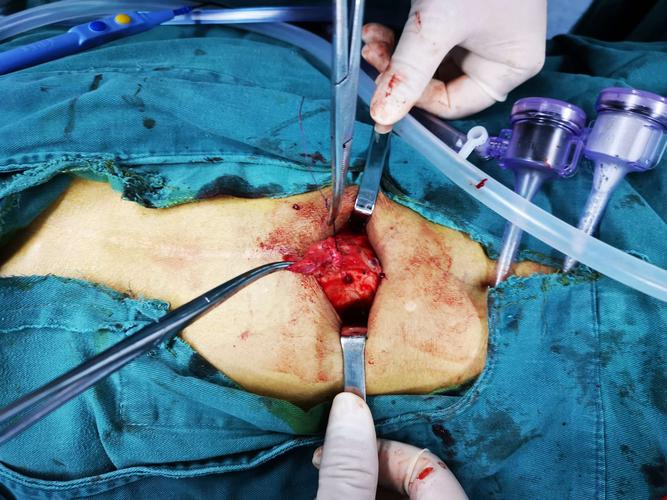 肝硬化腹水合并右侧腹股沟疝,脐疝,上腹部切口疝的一次性sublay解决