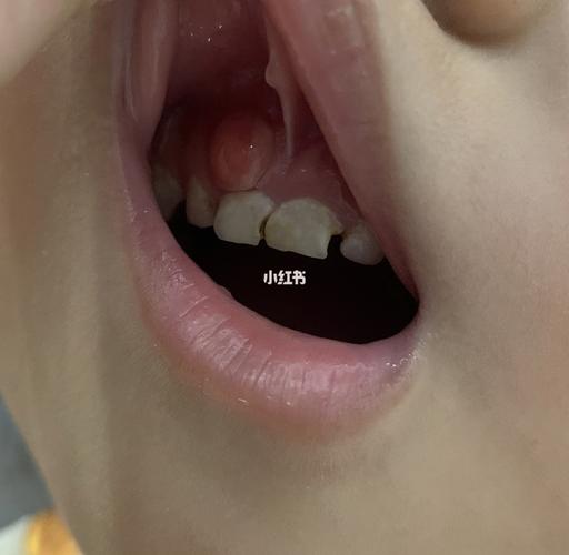 孩子牙龈肿包 牙根吸收_拔牙_母婴_育儿经验