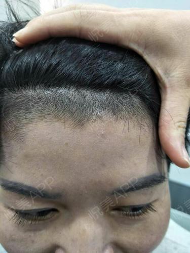 发际线太低了,很苦恼,很羡慕那些大脑门的朋友,前几天去剪头发让理发