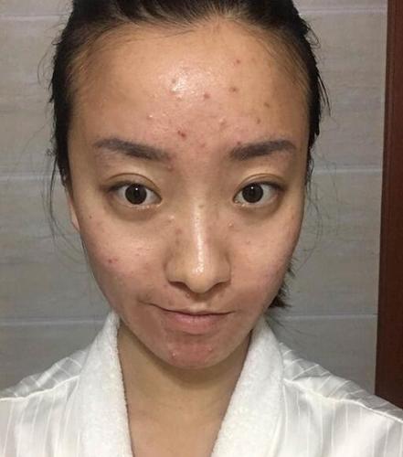 分不清痘痘还是螨虫?四个方法教你识别螨虫痘,拒绝"螨虫脸"