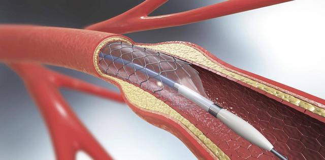 心脏支架是救人还是害人做完人就不行了医生告诉你实情