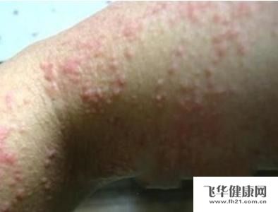 性病通常是不洁性交,性交泛滥导致的这种疾病.