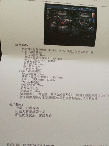 我怀双胞胎,19周 1天的时候做b超胎心正常,今天已经20