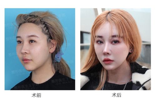 苹果肌吸脂修复丨案例分享