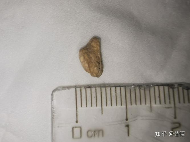 7毫米输尿管结石排出经历分享