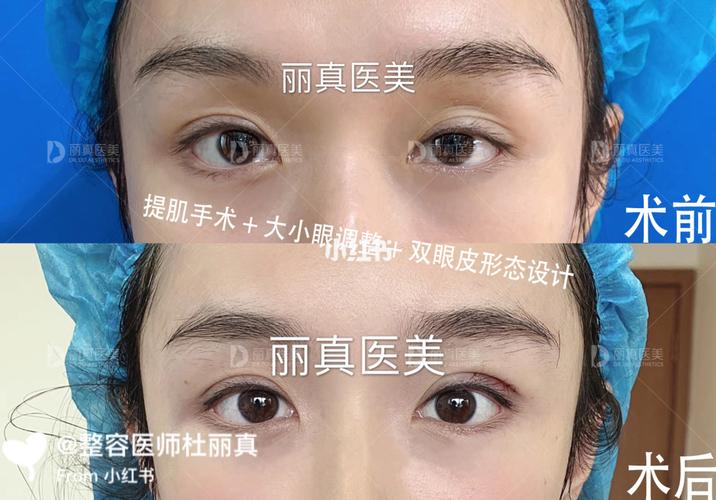 提肌手术77大小眼调整77双眼皮形态设计,术后即刻效果_医疗美容