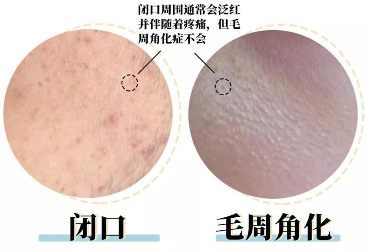 "鸡皮肤"是毛周角化症,算是一种皮肤病.