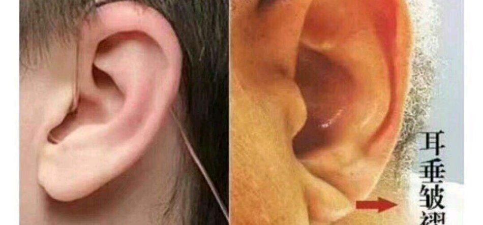 【冠状沟】如果耳垂有对角线型皱褶,要注意了