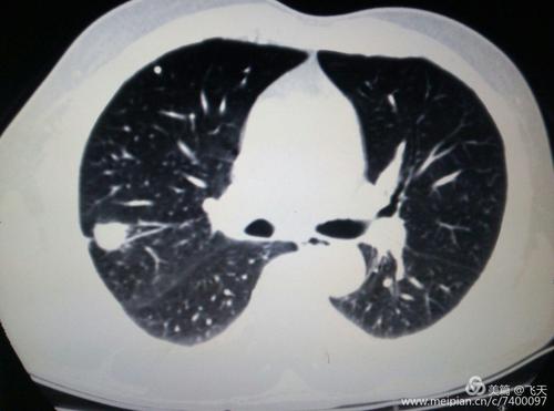 术后病理结果为结核球.