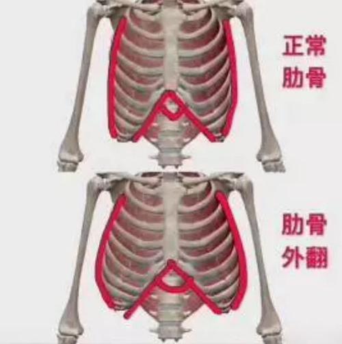 肋骨外翻可以有好身材么