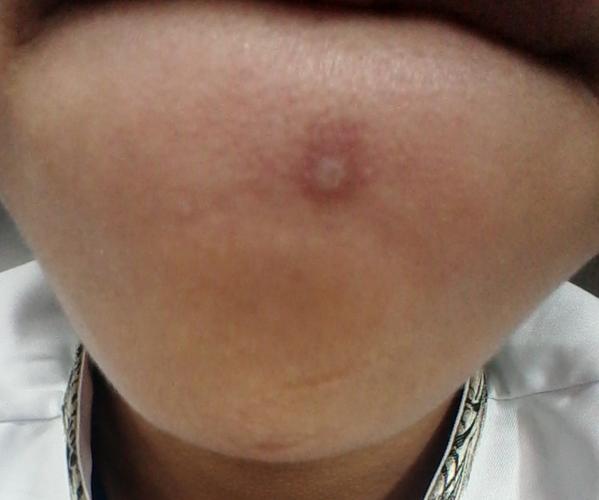 这个痘痘很白但没出口,挤才挤出一点点现在结痂,洗澡的时候不小心弄掉