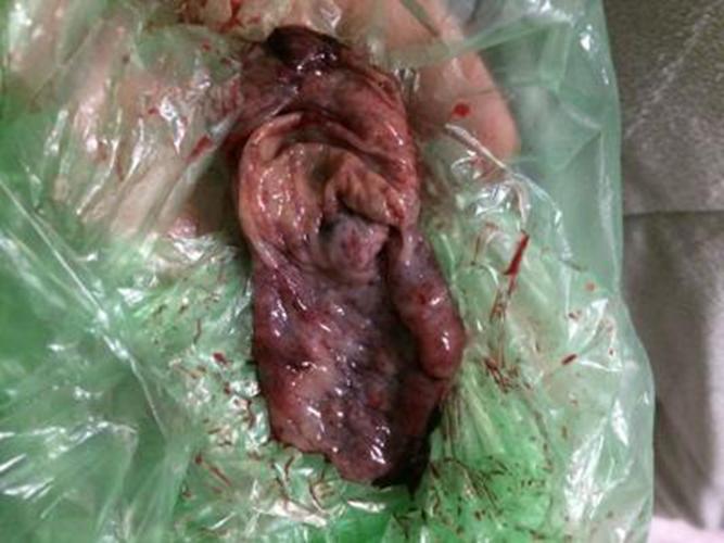 早孕药流排出的孕囊形状图片