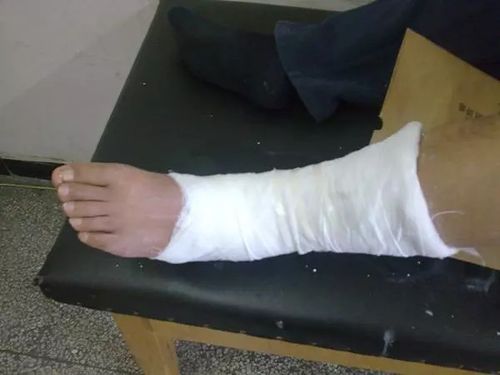 柔软的绷带不能起到强有力的加压包扎控制减少出血和固定踝关节的