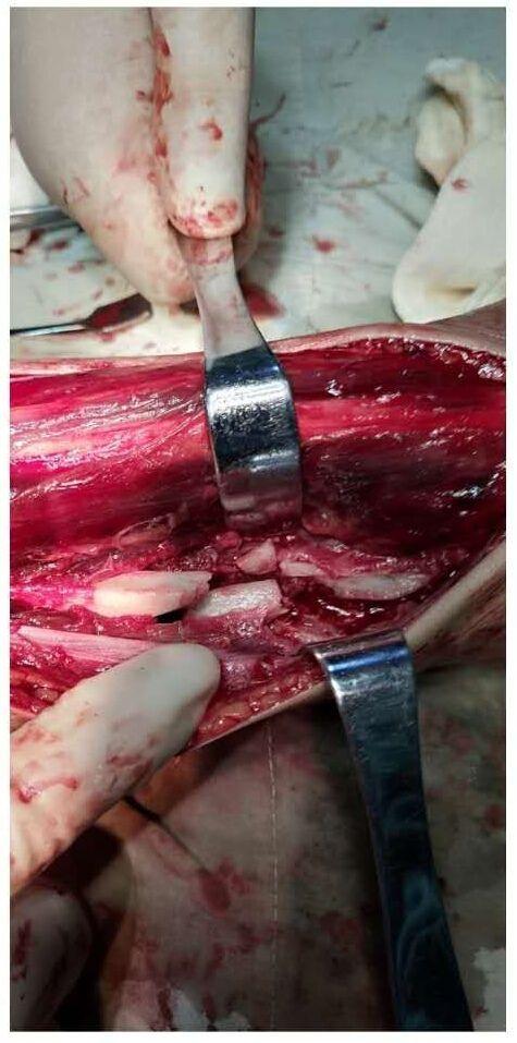 胫腓骨中下段粉碎性开放性骨折急诊切开复位内固定术