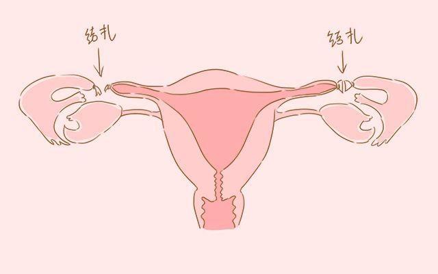 男方还是女方做结扎好?