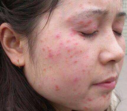 季节性面部皮炎