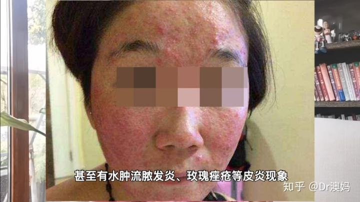 看完这篇你还不懂激素脸/激素依赖性皮炎的修复,算我输!