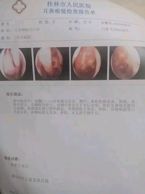 做了个鼻内镜,取了个鼻咽部淋巴组织的活检,结果还没出.