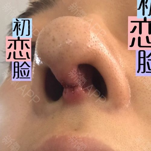 医院给我的回复是正是疤痕增生期,以后会长好.
