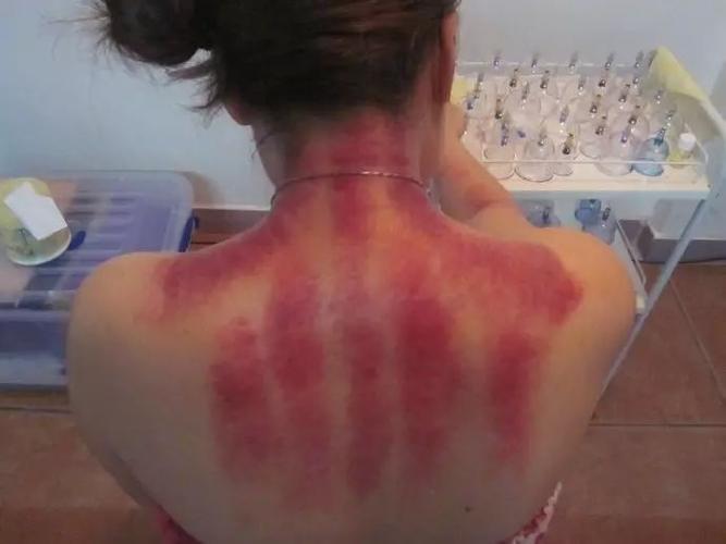 人体内如果有风湿之气,在刮痧时就会出"痧",但是这种风湿之气不是引起