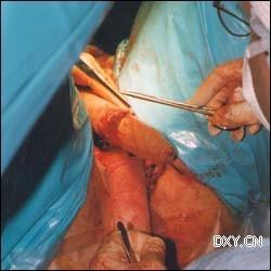 男人变女人 变性手术过程图示