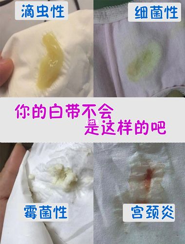 我的内内终于恢复正常了75157515_质地_经期_白带异常_医疗