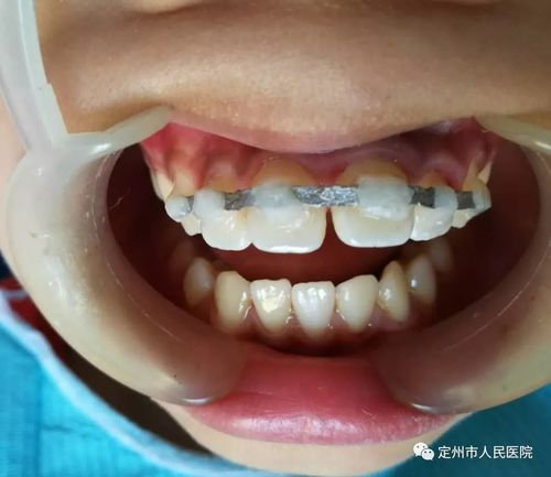 陆医生为他检查后,发现脱位牙齿已重新长合,便将牙弓夹板摘除