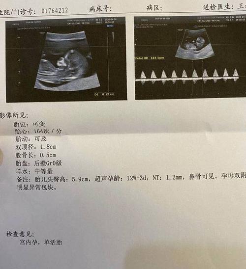 nt单可看男女准确率90nt可以看男女吗