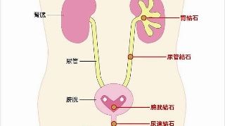 双侧输尿管结石的手术治疗原则是什么?谨遵这三点!