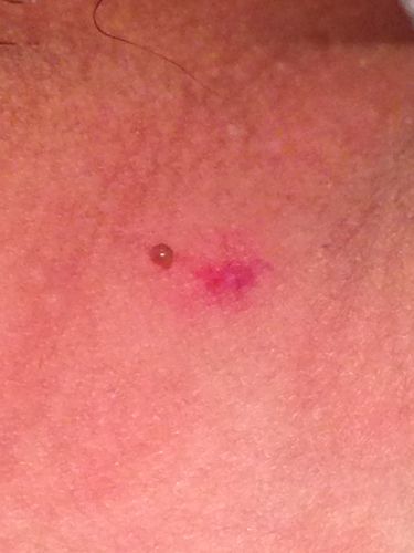 大腿根部 阴囊旁边 有黑色突起物 有点像泡 但又扣不掉.