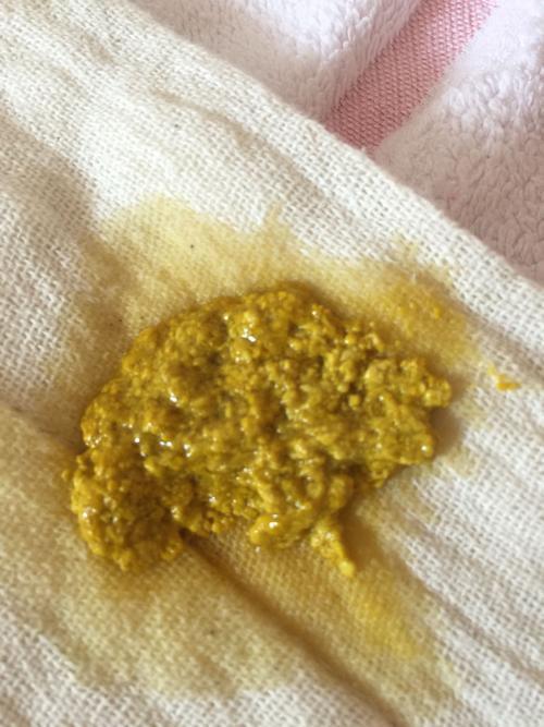 这是二十几天的婴儿的大便,请问是拉肚子吗?