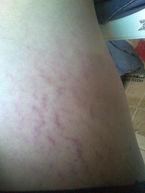 大腿内侧两边长紫红色的斑纹