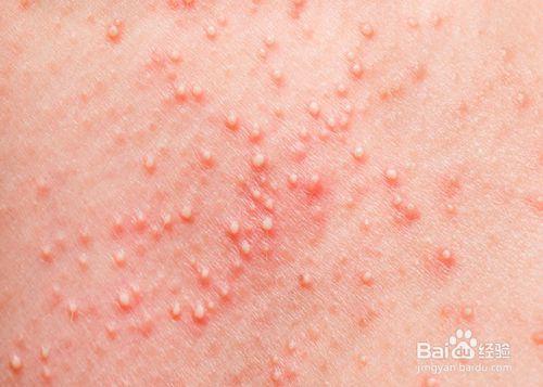 宝宝皮肤过敏怎么预防和护理