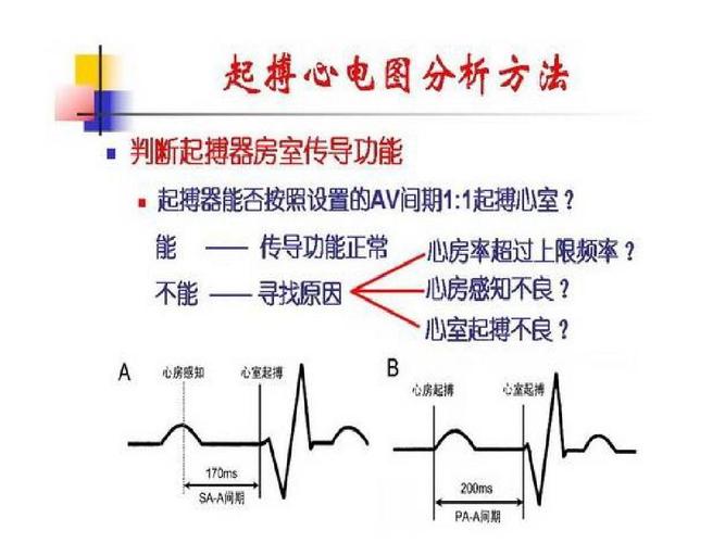 起搏器心电图分析ppt